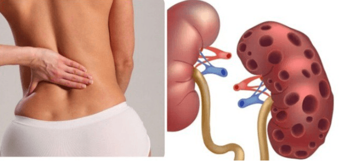 Dấu hiệu suy thận ở nữ giới dễ bị bỏ qua: Cảnh báo âm thầm, nhiều người phát hiện khi đã muộn | Phòng Khám Y Khoa Số 10 Trần Điền