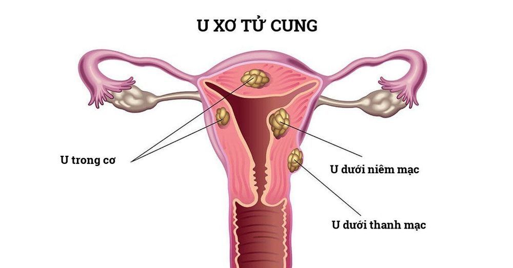 Chú ý với cảm giác khó chịu ở vùng kín: Dấu hiệu cảnh báo nhiều bệnh phụ khoa
